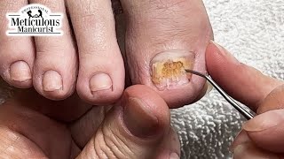 Big Toenail Fix at Home nails satisfying [upl. by Kendre936]