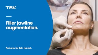 Filler jawline augmentation using cannula [upl. by Aicemaj]