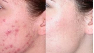 Remedio Secreto  Elimina Acne amp Manchas con VINAGRE  Resultados en dias [upl. by Neelyt392]