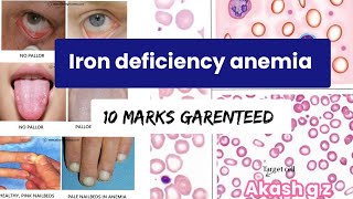 iron deficiency anemia  10 marks  medicomanindia [upl. by Wier]