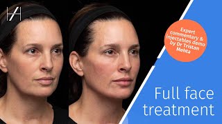 Full Face Dermal Fillers Treatment Demonstration by Dr Tristan Mehta [upl. by Assereht]