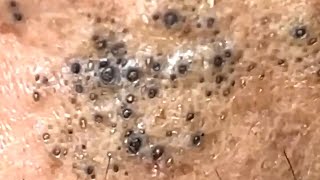 Blackheads Satisfying Removal 0003 [upl. by Ahcsas]