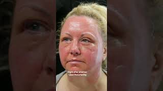 Laser Skin Resurfacing shortvideo shorts transformation [upl. by Nevag]