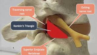 Lumbar Transforaminal Approach for Disc Herniations [upl. by Tteve]