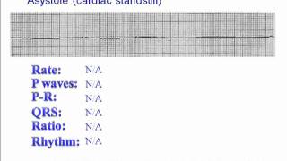 ECG Asystole [upl. by Coniah781]