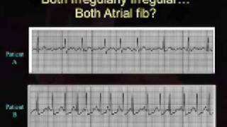 Intro EKG Interpretation Part 3 [upl. by Francyne]