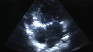 Tricuspid Atresia Echocardiogram [upl. by Nirhtak]