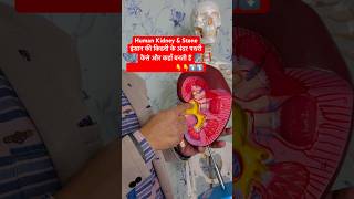 Human Kidney amp Renal Stone  इंसान की किडनी के अंदर पथरी कैसे और कहाँ बनती है viral shorts kidney [upl. by Aehtna]