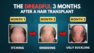 The DREADFUL First 3 Months after a Hair Transplant [upl. by Alice]