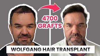 4700 Grafts Hair Transplant Results  Before amp After of Wolfgang [upl. by Diad37]