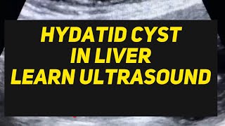 Hydatid Cyst in Liver ultrasound case  learn usg [upl. by Anaiq739]