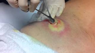 Lancing infected cyst  abscess [upl. by Ased]