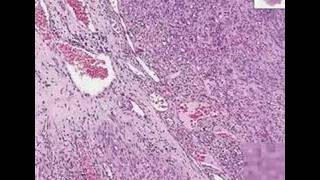 Histopathology SkinKaposi sarcoma [upl. by Anhej]