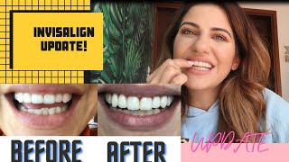 PART 2 UPDATE για τα Invisalign μασελάκια 😁 [upl. by Dempstor]