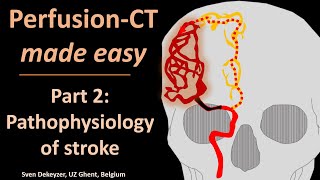 Perfusion CT made easy  part 2  pathophysiology of acute ischemic stroke [upl. by Deva]