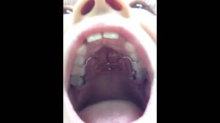 Palatal Expander Getting Braces On Nirenblatt Orthodontics [upl. by Halehs601]