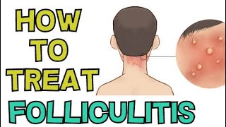 HOW TO TREAT FOLLICULITIS FAST [upl. by Lochner228]