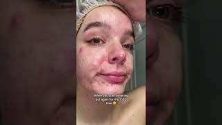 Coming to terms with my acne on my skin healing journey realskin [upl. by Mcgean]