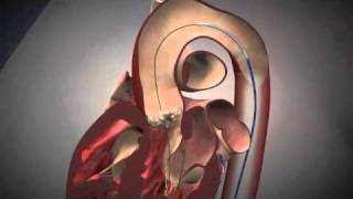 Fluoroscopy and Animation of the TAVI Procedure  NEJM [upl. by Reldnahc]