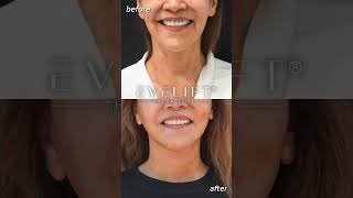 Patient Before And 1 Week After EVE Lift™  Eden Plastic Surgery Dr Ali Charafeddine MD [upl. by Chrystel941]