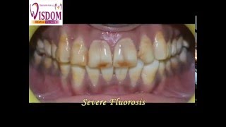 Treatment of Severe Fluorosis [upl. by Cousin]