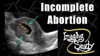 Incomplete Abortion  RPOC  Ultrasound  Case 166 [upl. by Ytoc875]