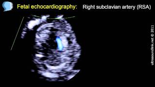 Fetal Echocardiography During Pregnancy  Dr Prashant Mahawar [upl. by Mackoff]