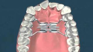 Expasion palatina rapida  Ortodoncia [upl. by Chadburn661]