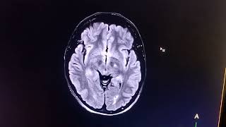 MRI Brain planning شرح بسيط لفحص الرنين على المخ [upl. by Opal]