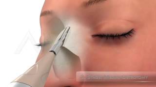 Video Endoscopic Micro Rhinoplasty Dr Yakup Avsar [upl. by Sondra]