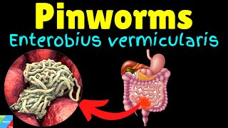 Pinworms Threadworms Symptoms Causes Treatments Life Cycle – Enterobius vermicularis [upl. by Davilman]