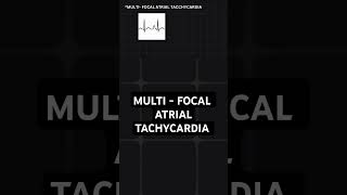 multifocal atrial tachycardia  ECG basics [upl. by Carrie]