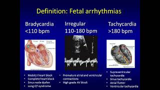 Fetal Arrhythmias and Management by David W Brown MD FAAP [upl. by Quince]