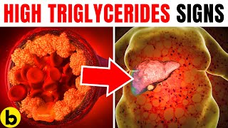 High Triglycerides Warning Signs You Should Know About [upl. by Sivatco97]