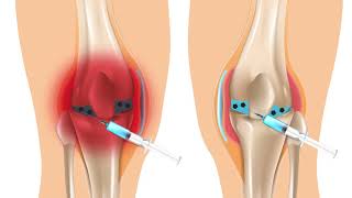 Synovial fluid biomarkers give a glimpse at the intra articular environment after a meniscal injury [upl. by Enert876]