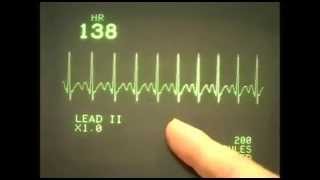 EKC ECG rhythms 1 Normal range of rhythms [upl. by Nnylirej]