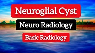 Neuroglial Cyst  Neuro  Radiology [upl. by Gaspar578]