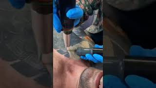 SUSLASER PICOLASER Tattoo Removal Removing Tattoo On The Chest [upl. by Kevan]