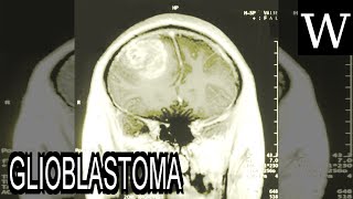 GLIOBLASTOMA  WikiVidi Documentary [upl. by Capriola]