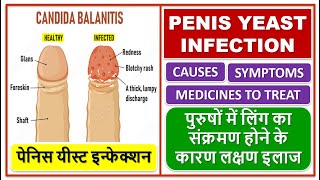 PENIS YEAST INFECTION TREATMENT पेनिस यीस्ट इन्फेक्शन लिंग का संक्रमण होने के कारण लक्षण इलाज [upl. by Norek]