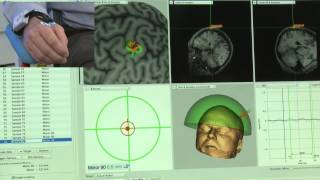 TMS Current Direction Control Over Targeted Brain Area [upl. by Llenra]