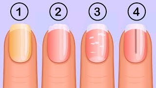 5 Things Your Nails Can Tell You About Your Health [upl. by Homans]