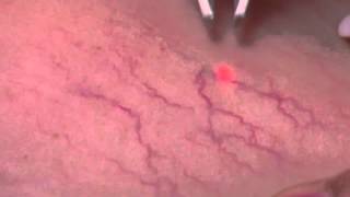 Spider Vein Treatment at JVAI [upl. by Tengler]