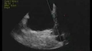 intracardiac echocardiography ICE [upl. by Ayotas]