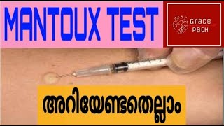 Mantoux Test  Tuberculin Skin Test TST Malayalam [upl. by Aiykan]