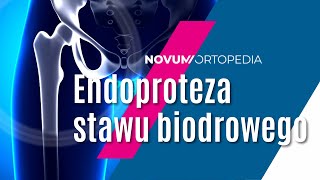 Budowa i funkcjonalność endoprotezy stawu biodrowego  Novum Ortopedia [upl. by Naugal]