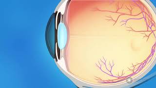 What is glaucoma [upl. by Dougald522]