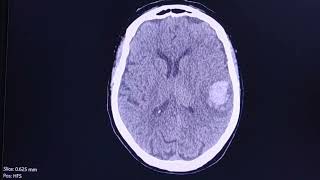 Acute haemorrhagic brain infarct  CT findings [upl. by Cory534]