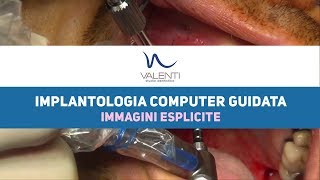 Chirurgia Orale Implantologia computer guidata  Stdio Dentistico Valenti [upl. by Atinav832]