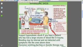 SESSIONS for NURSES 9  THE PATIENT IN HYPOVOLEMIC OR SPINAL SHOCK [upl. by Teiluj]